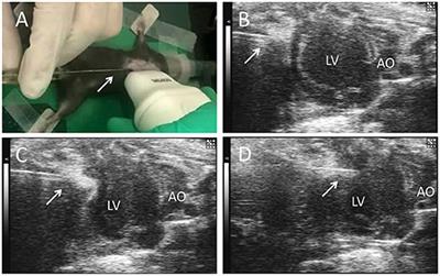 Cardiac Repair With Echocardiography-Guided Multiple Percutaneous Left Ventricular Intramyocardial Injection of hiPSC-CMs After Myocardial Infarction